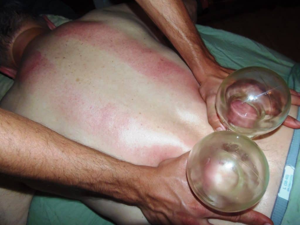 Massage Cupping: Feeling Issues in the Tissues
