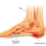 Bodywork Techniques for Plantar Fasciitis