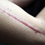 Six Massage Techniques to Remove Scar Tissue