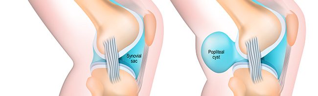 Illustration of healthy knee compared to a knee with a Baker's or popliteal cyst