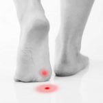 Plantar Wart Detection for Bodyworkers
