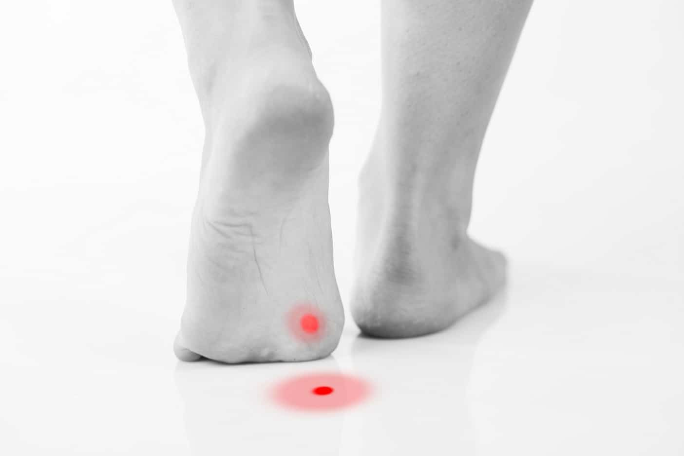 Plantar Wart Detection for Bodyworkers Massage Professionals Update
