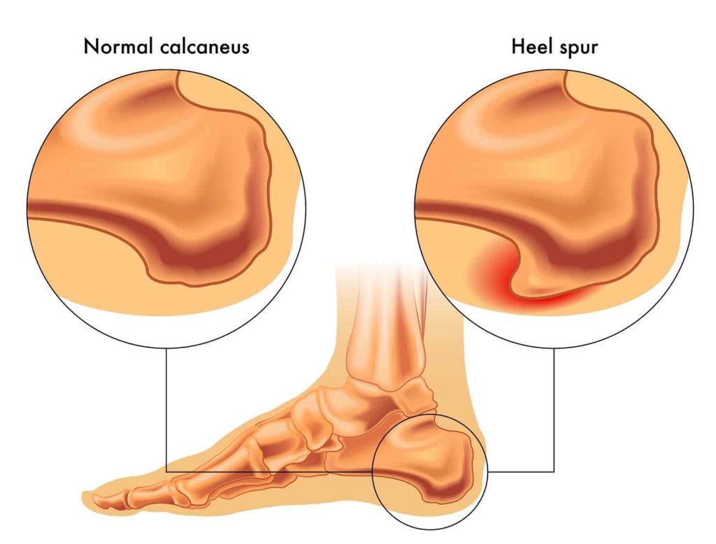 heel extra bone