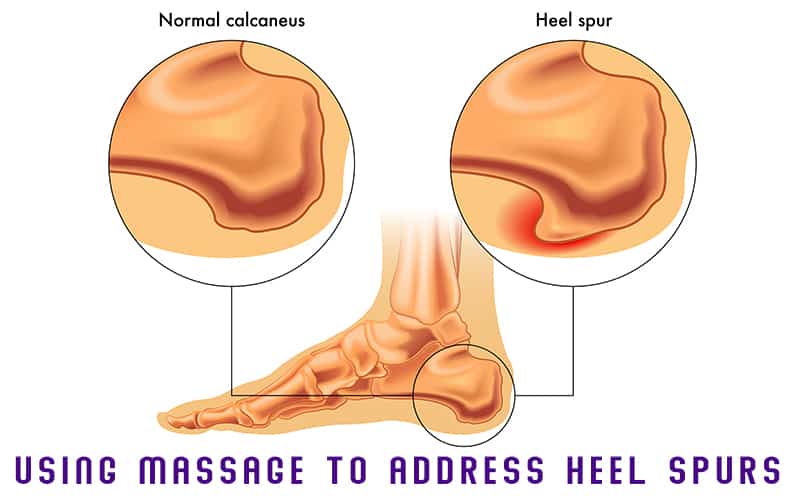 Using Massage to Address Heel Spurs