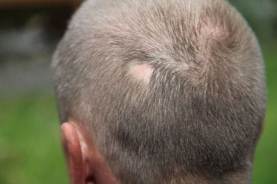 Aromatherapy Massage for Alopecia Areata
