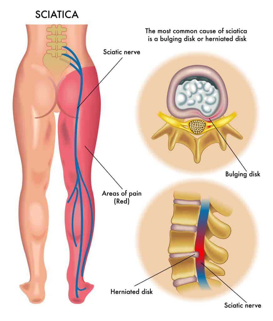 Deep massage for sciatica Clearance