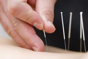 Acupuncture has a positive impact on hip injuries.