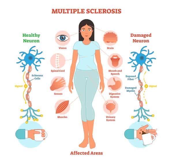 Signs and symptoms of Multiple Sclerosis