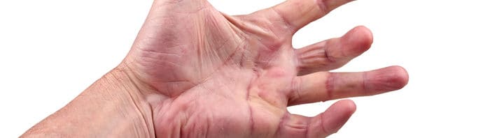 Massage Techniques for Managing Dupuytren’s Contracture