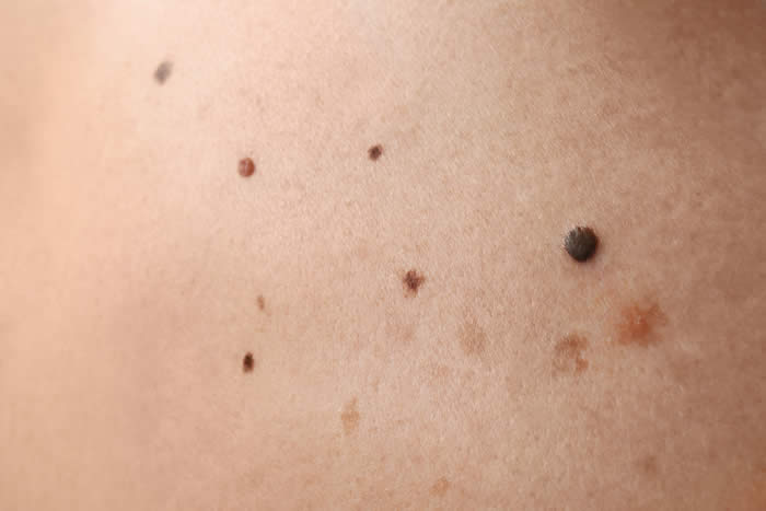 Know how to assess moles during a massage session.