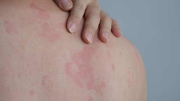 Do not massage a skin rash.